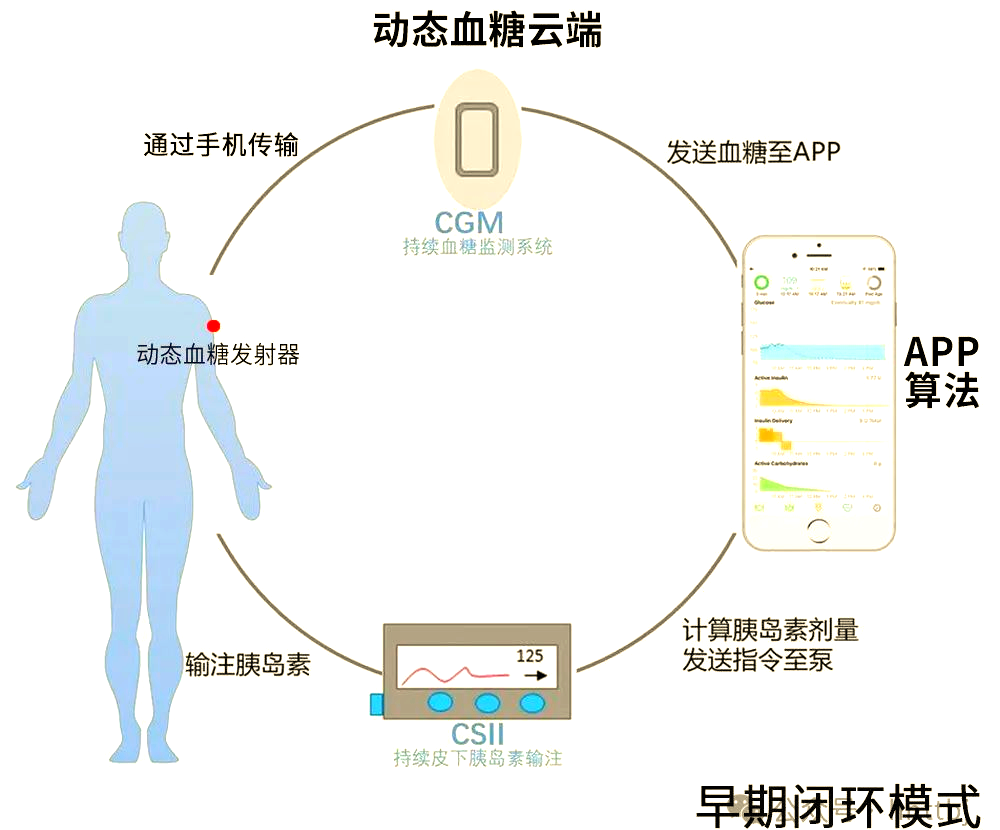 美敦力780g 革命性的閉環式胰島素泵，引領高效、穩定與精確的糖尿病管理